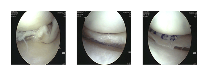 연골판 파열 - 사진