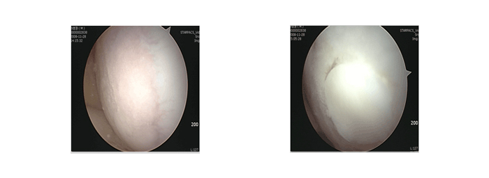 자가 골연골 이식술 - 사진