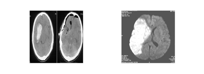 뇌출혈 - 사진, 일러스트